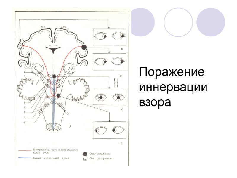 Поражение иннервации взора
